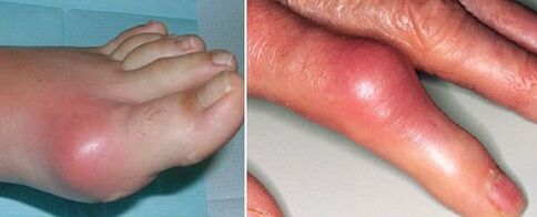 поява на ставите с артрит